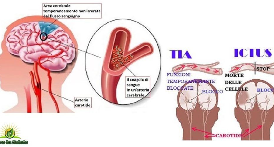 Sintomi premonitori di un ictus