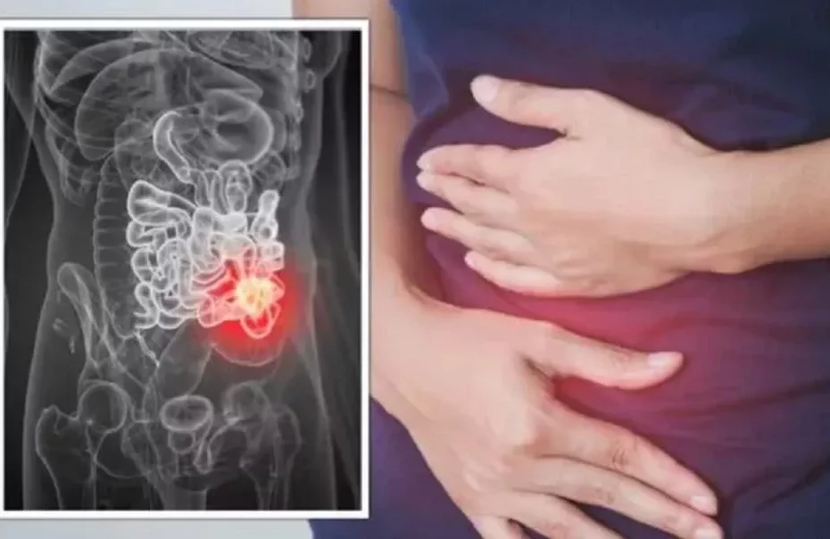 sintomi intestino irritabile